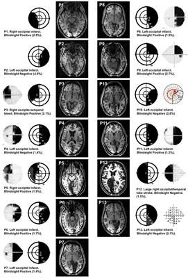 The Superior Colliculus and Amygdala Support Evaluation of Face Trait in Blindsight